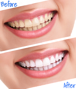 Cheap Teeth Whitening