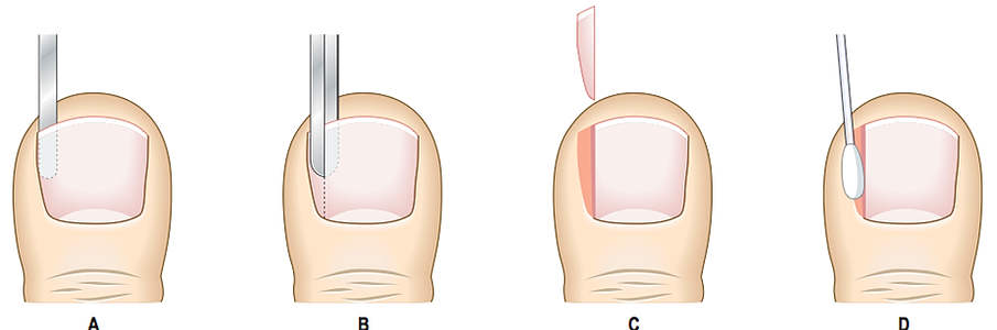 Common Nail Problems: Conditions, Treatments, and Pictures ...