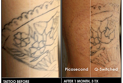 Tattoo Before and after 1 month with PicoSure Picosecond Laser vs Q ...