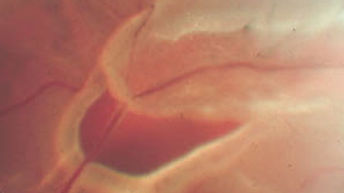 Rotura Retiniana.jpg