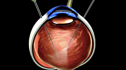 Vitrectomia Posterior Via Pars Plana.jpg