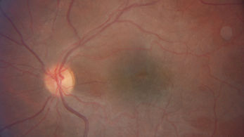 Membrana Epirretiniana.JPG