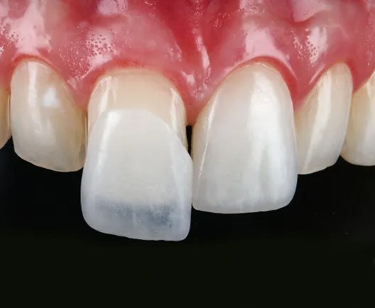 tooth veneers