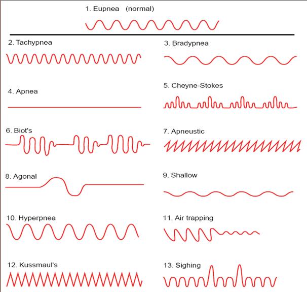 Biot's respiration and Cheyne Stokes Respiration.