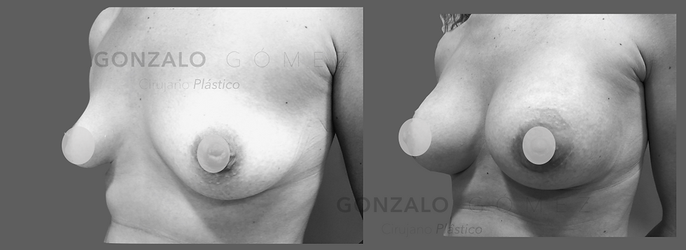 Aumento Mamario / 2 hijos, 35 años / Subglandular