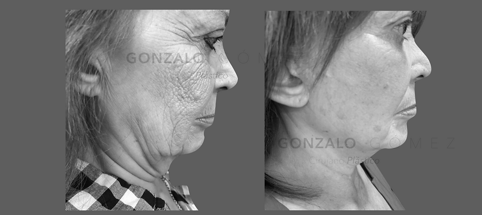 Lifting Facial Pitanguy