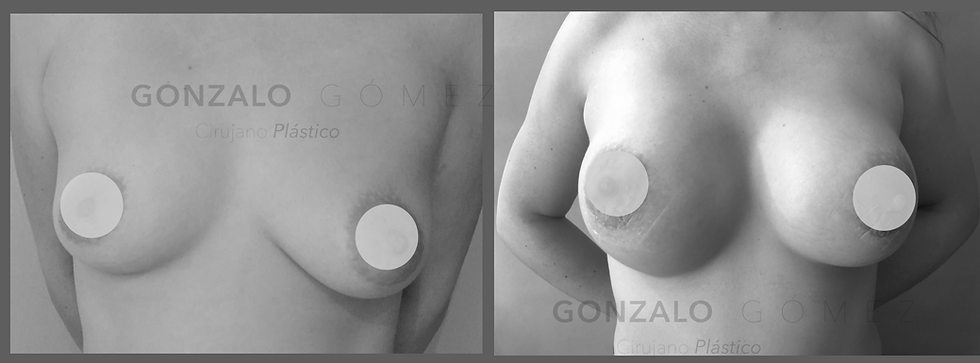 Mastopexia de simetría con implantes