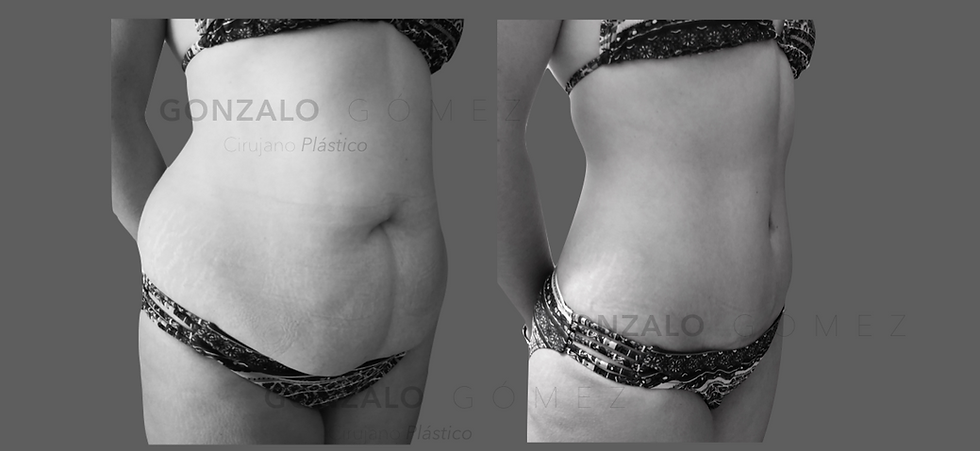 Abdominoplastía / Lipo Vaser