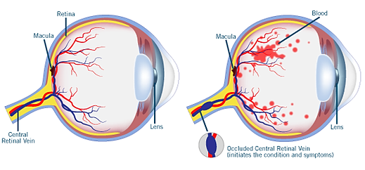 Resultado de imagen de central retinal vein occlusion