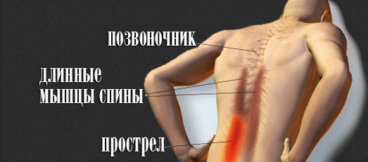Прострелы внизу поясницы Прострелы внизу поясницы