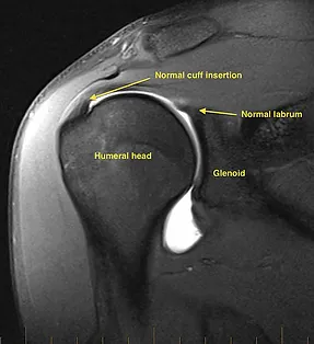 rotator cuff tear mri