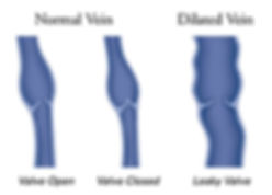 Vein Conditions