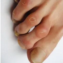 soin cors au pied
