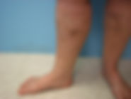 Varicose Veins After Treatment