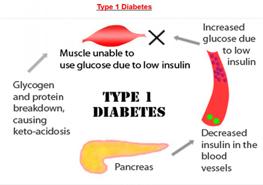 varför får man diabetes varför får man diabetes