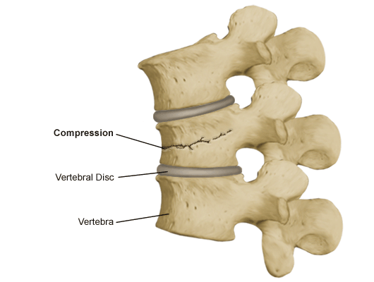 compression_fracture.gif
