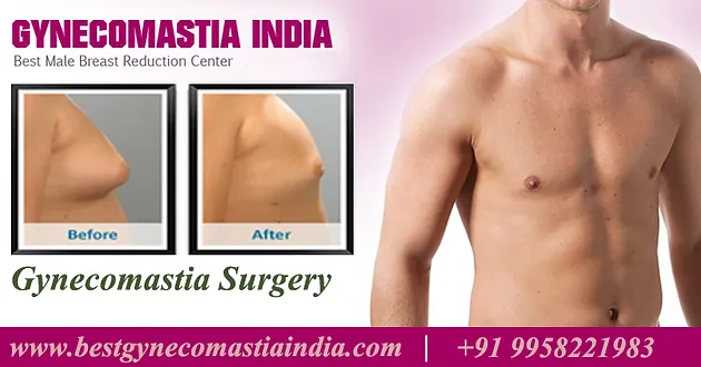 gynecomastia male breast reduction surgery Gynecomastia male breast reduction surgery
