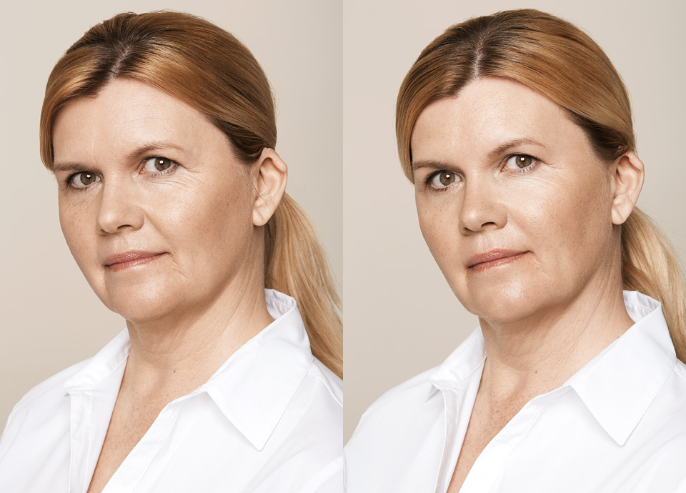 Филеры В Косметологии Фото До И После – Telegraph