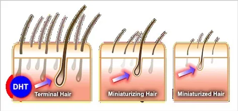 Quick Facts About Baldness