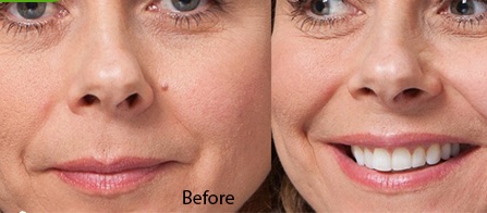 mole removal at medico global medico global medical mole removal at medico global medico global medical
