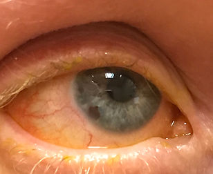 eye photo with blepharitis deposits