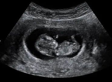 Dating scan purpose, philippines anal