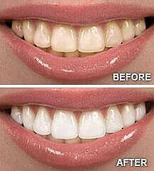 oil pulling before and after