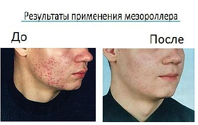 эффективность мезороллера