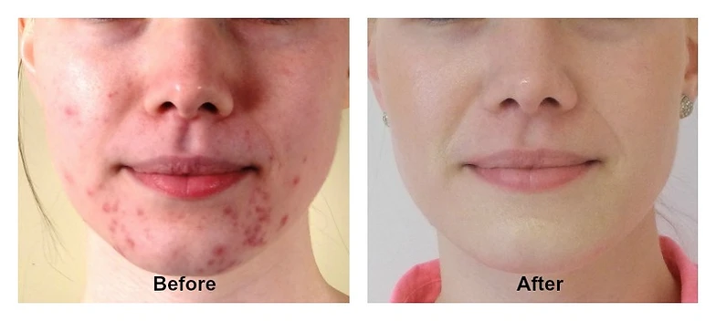 clovisdermatology acne