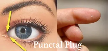Punctal Plugs Dry Eye Center Punctal Plugs