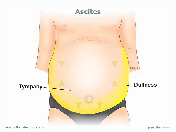 What is abdominal distension