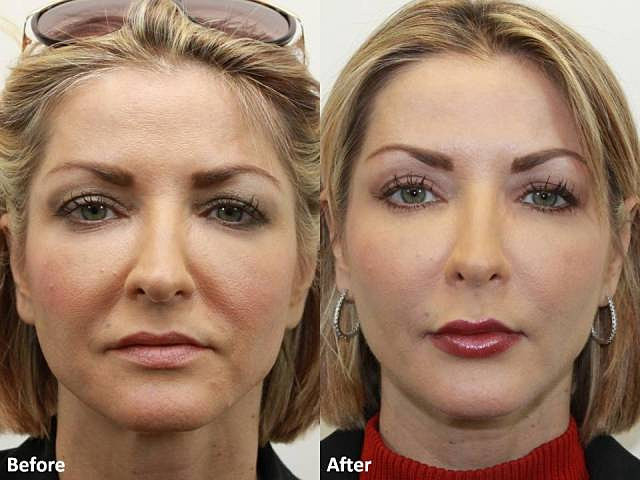 Breast Lift Before And After