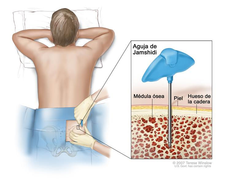 osea - Trasplante de células madre de la médula ósea y de sangre del cordón umbilical 952eab_e169221344f343c5ac2c7829d2a6e42c