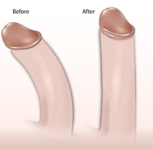 How To Cure Curved Penis 90