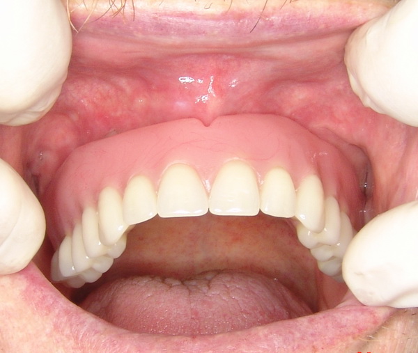 overdenture barra clip superior alternativas ao uso de pr 243 teses totais convencionais overdenture barra clip superior alternativas ao uso de pr 243 teses totais convencionais