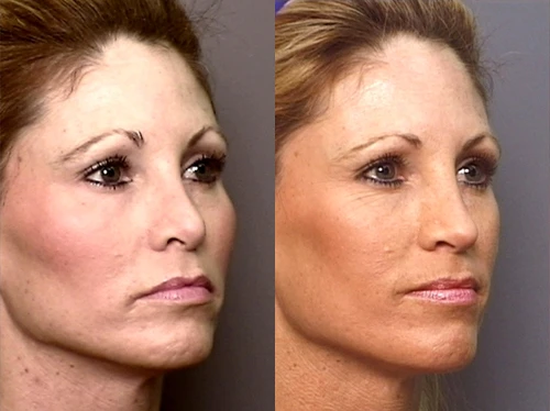 Lebron James Fat Facial Implants Pictures