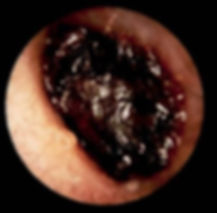 Otorrinolaringología| Dr. Elías Legorreta| Cerumen