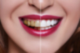 Woman Teeth before and after dental trea