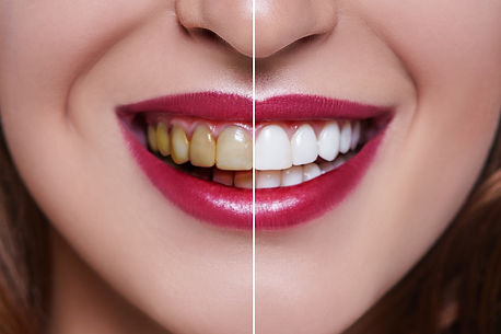 Woman Teeth before and after dental trea