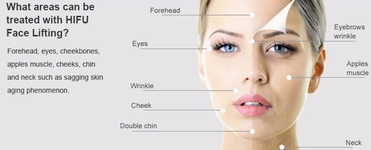 HIFU face forhead eyes wrinkle cheek double chin