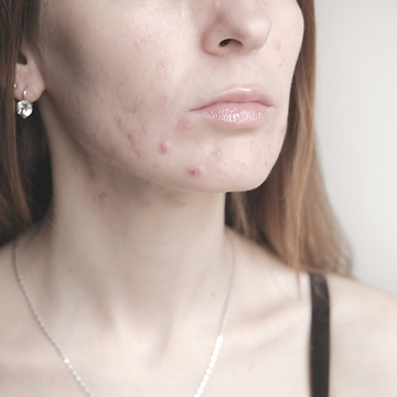 Mask Acne and how to fix it