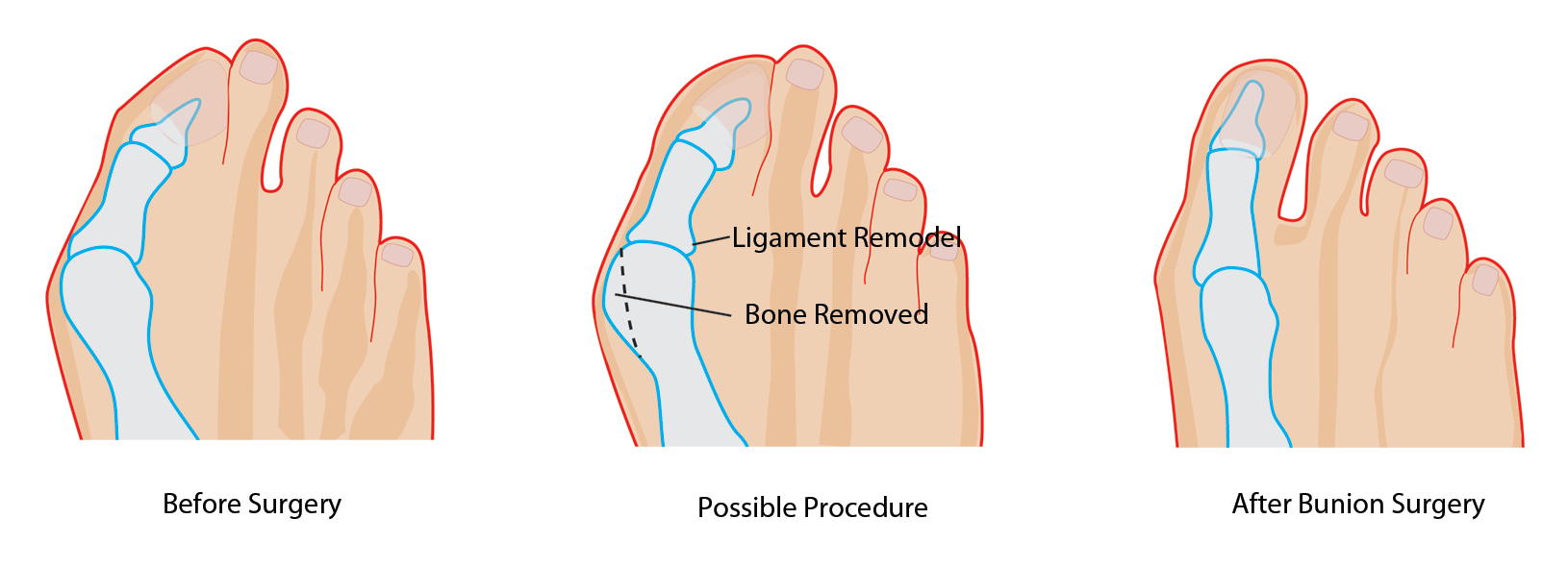 Hammertoe