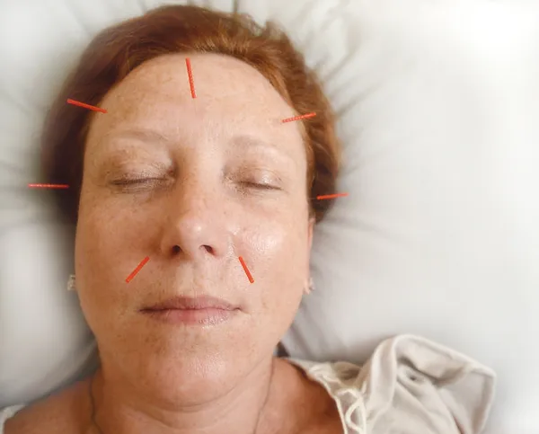 Facial acupuncture pictures Butt cum shots