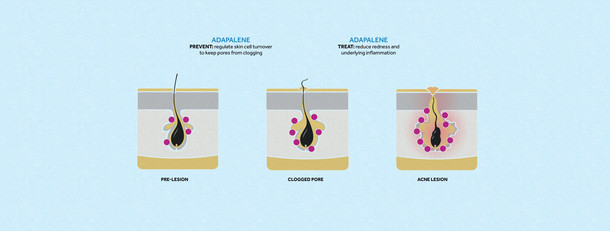 Adapalene: the retinoid for full-on acne domination. Differin.com