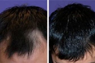 prp for hair.jpg