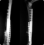 Osteosarcoma_05.png