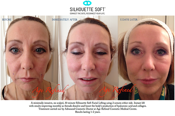 silhouette soft lift ervaringen