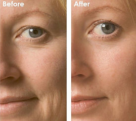 hollow spa dermaplaning hollow spa dermaplaning