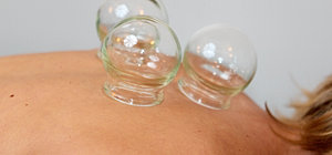 Cupping Therapy Alyssa Melody