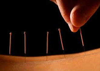 Acupuncture Arcata 